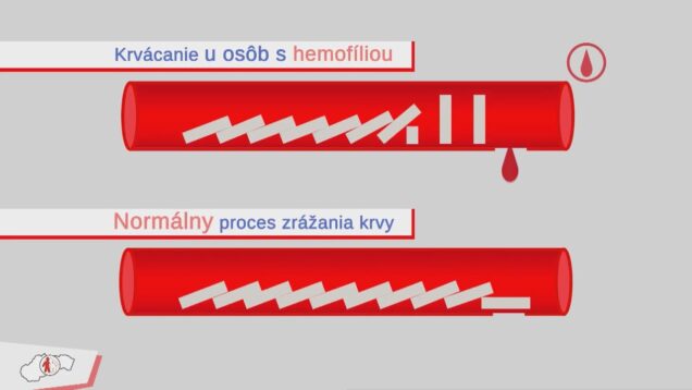 Aj malé zranenie sa môže stať bojom o život. Svetový deň hemofílie pripomína ľudí, ktorý žijú s nebezpečným ochorením celý život